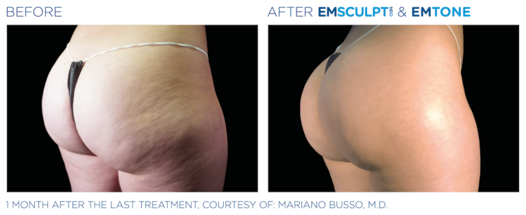 Side by side before and after image of female's bottom with Emsculpt NEO and Emtone treatments at Marcos Medical. Left Image shows before - skin is not smooth, fat texture is prevalent. Right image shows after - skin is entirely smooth and brighter, no evidence of lines from fat. One month after the last treatment, courtesy of Mariano Busso, MD.