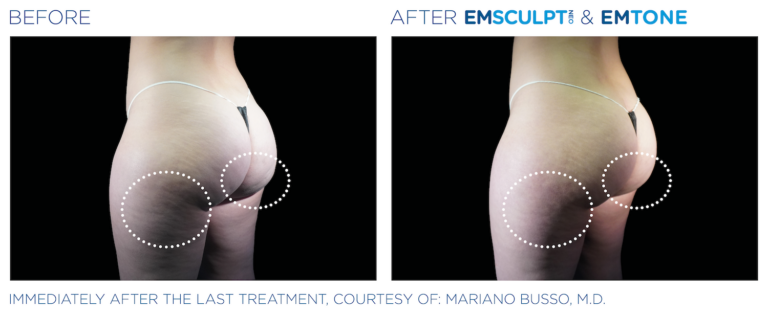Side by side before and after images of woman's bottom with Emsculpt NEO and Emtone treatments. Left image is before, and areas of fat are circled - right underneath the bottom and on the bottom. The right side shows the after, with the same areas circled - less fat and wrinkles visible. Immediately after the last treatment, courtesy of Mariano Busso, MD.