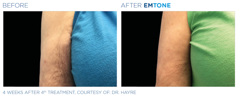 Side By Side Comparison of Woman's Upper Arm with Emtone Treatment at Marcos Medical. Left Image is Before - Wrinkled Skin On Arm. Right Image is After - Skin Smoother, Wrinkles Nearly Gone. Four Weeks After Fourth Treatment, Courtesy of Dr. Hayre