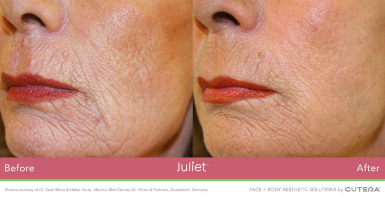 Before and After Image of Women's Wrinkles Being Reduced by the Juliet Facial Treatment at Marcos Medical. Image shows lower left half of face. Left Side of image Shows Before with Significant Wrinkles. Right Side of Image Shows After with Reduced Wrinkles and Even Skin Tone. Photos courtesy of Dr. Said Hilton and Heike Heise, Medical Skin Center, Dr. Hilton and Partners, Dusseldorf, Germany. Face and Body Aesthetic Solutions by Cutera.