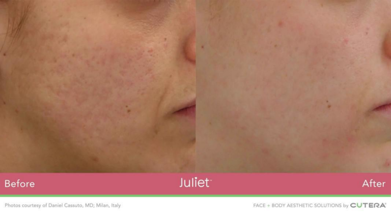 Side By Side Image of Cheek Before and After of Juliet Facial Treatment at Marcos Medical. Left Image Shows Before - Significant acne scarring on cheek. Right Image shows After with scarring significantly reduced. Photos courtesy of Daniel Cassuto, MD; Milan, Italy. Face and Body Aesthetic Solutions by Cutera.